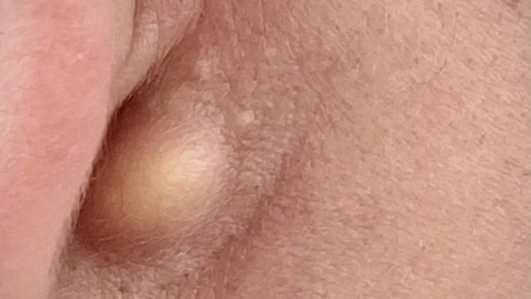 eingewachsenes haar intimbereich ursachen