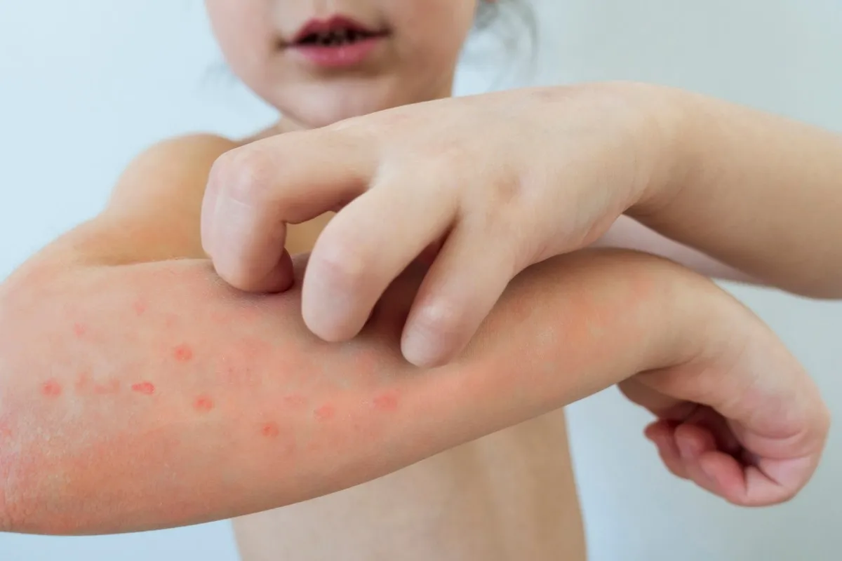leki na gorączkę ospa wietrzna u dziecka