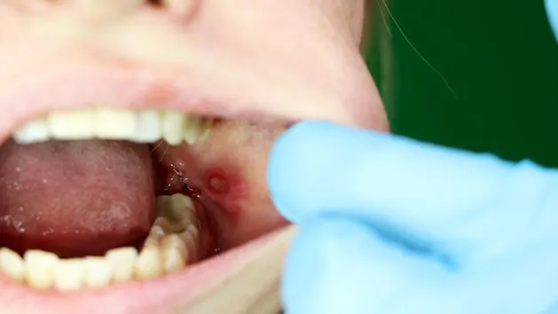 Zdjęcie Skuteczne sposoby na smarowanie nadżerek w jamie ustnej, które pomagają