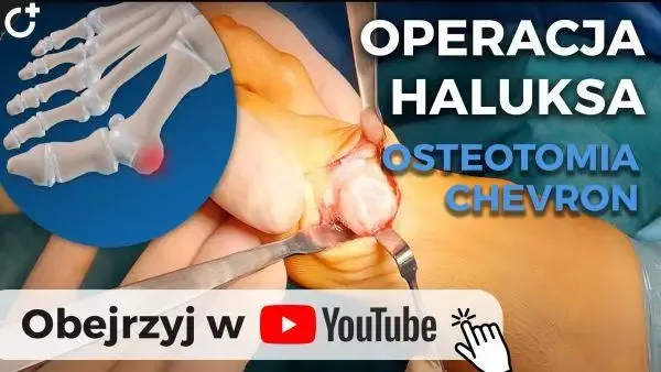cennik operacji haluksów