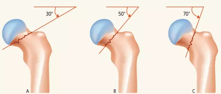 Schemat postępowania po złamaniu kości w Polsce