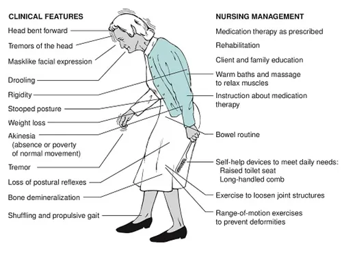 Objawy ruchowe choroby Parkinsona