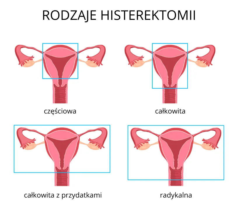 Rodzaje histerektomii schemat