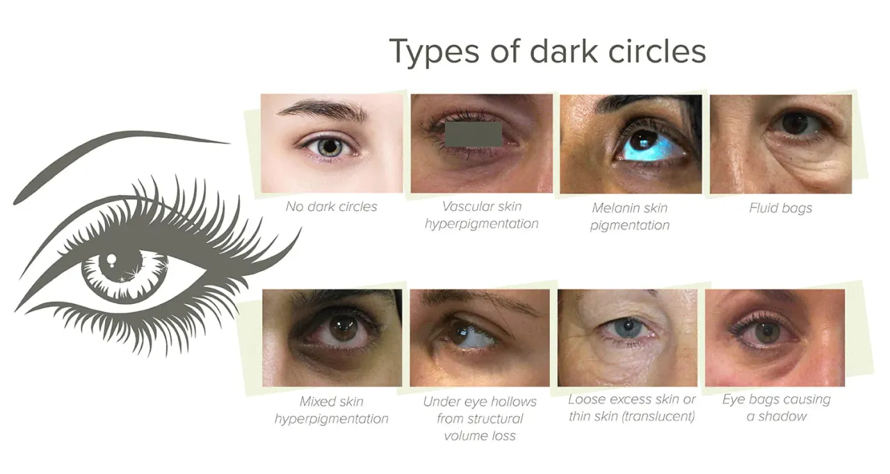 Anemia symptoms dark circles
