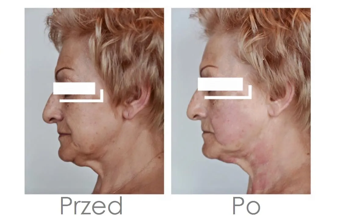zabiegi kosmetyczne RF HIFU laser