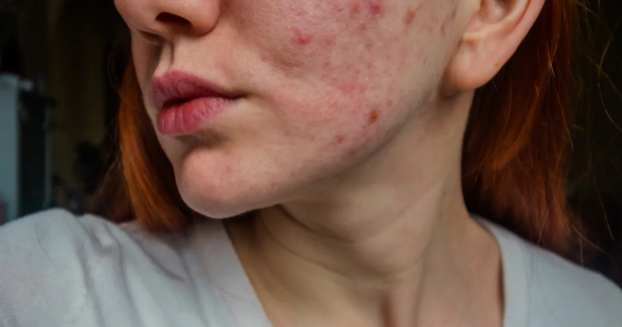 najczęstsze błędy w walce z trądzikiem