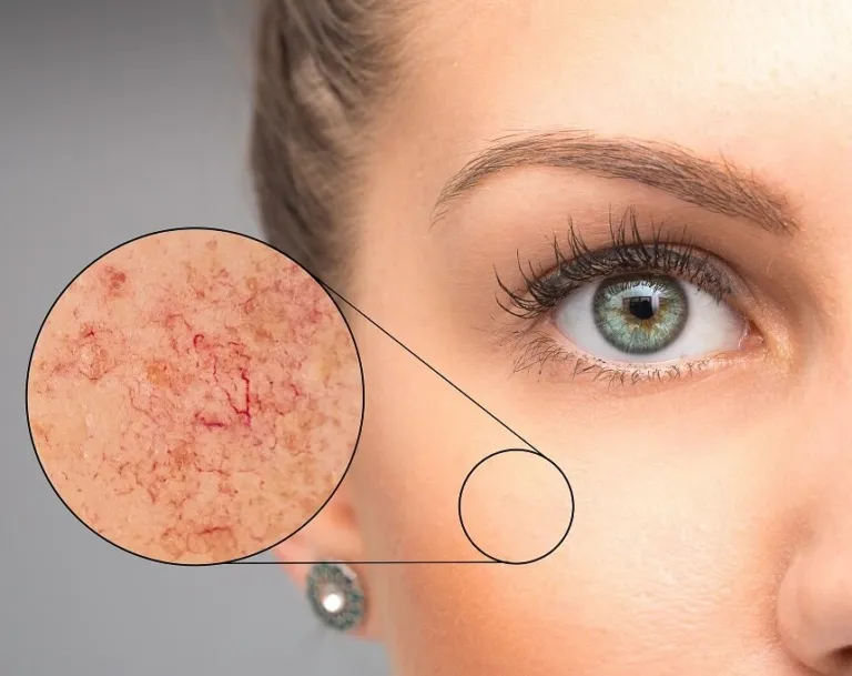 cera naczynkowa teleangiektazje pajączki na twarzy