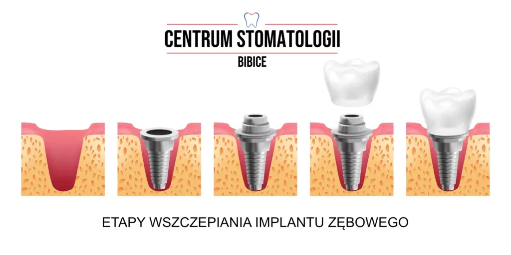 Etapy wszczepiania implantu zęba grafika