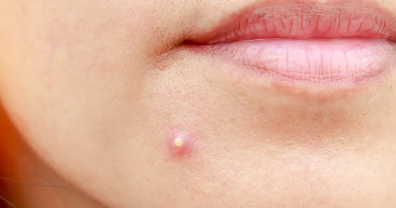 Widoczny ropny pryszcz obok ust. Jak się pozbyć takiego problemu, by skóra była gładka i zdrowa.