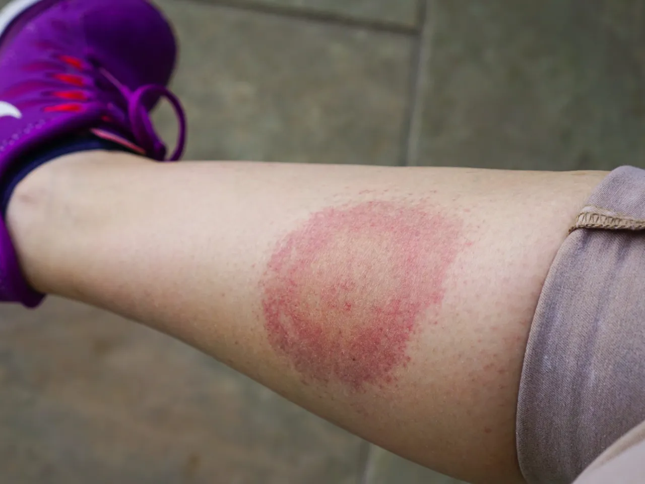 Objawy boreliozy i KZM