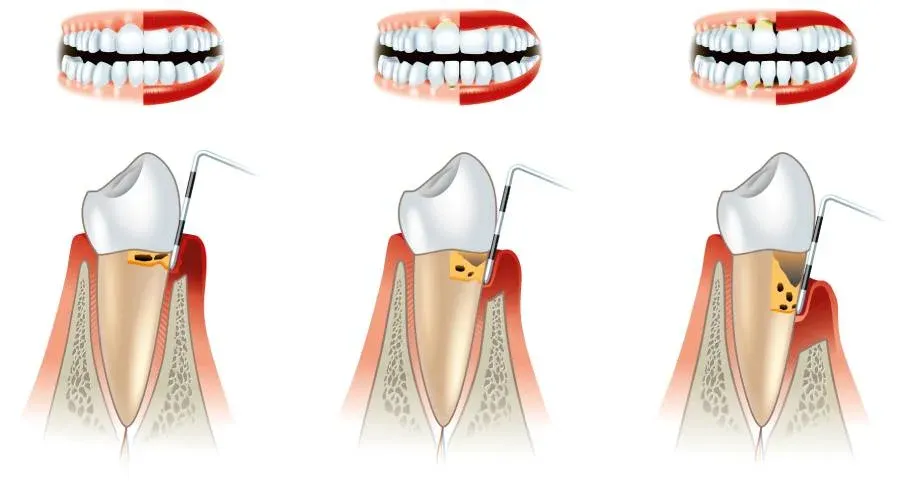 zabiegi periodontologiczne schemat