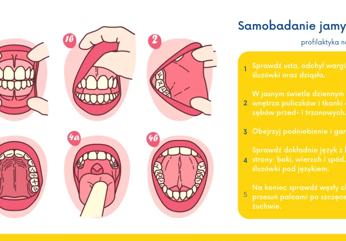 powiększone węzły chłonne szyi rak jamy ustnej