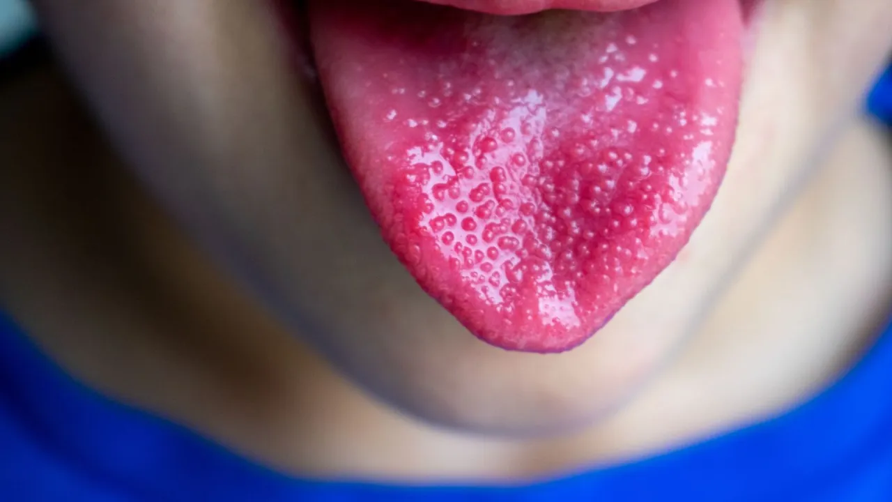 język malinowy szkarlatyna