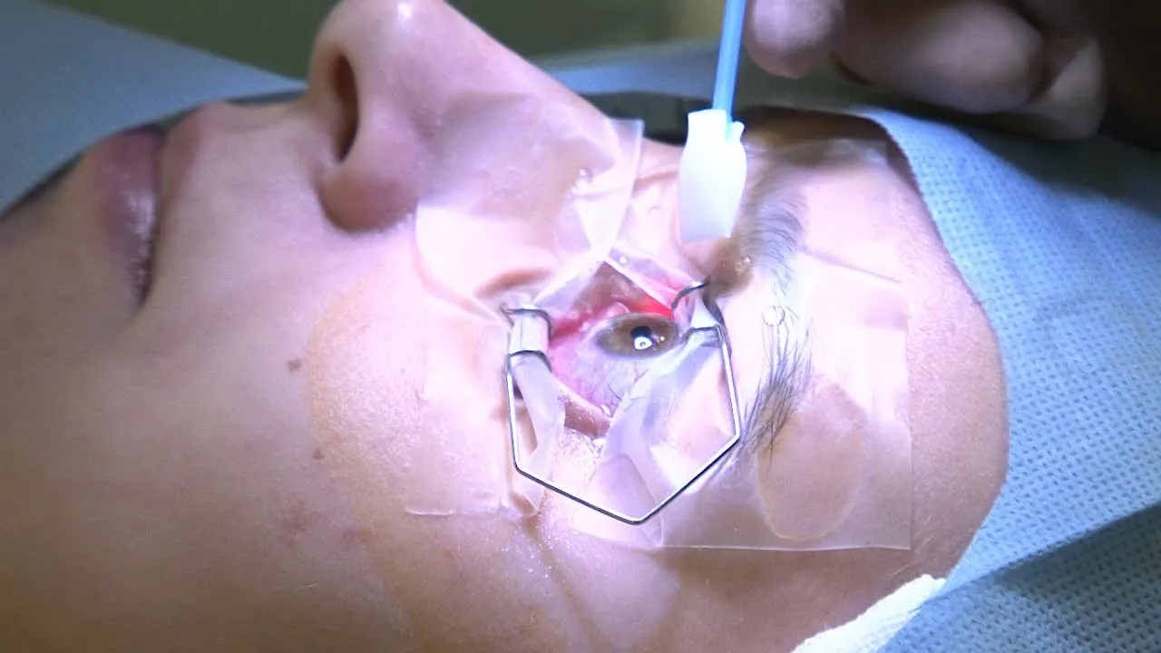 laserowa korekcja wzroku zabieg