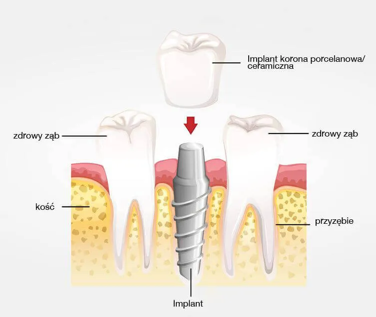 Cennik implant&oacute;w zębowych w Polsce infografika