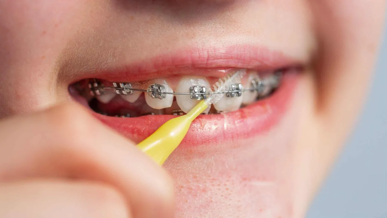 produkty do higieny jamy ustnej aparat ortodontyczny