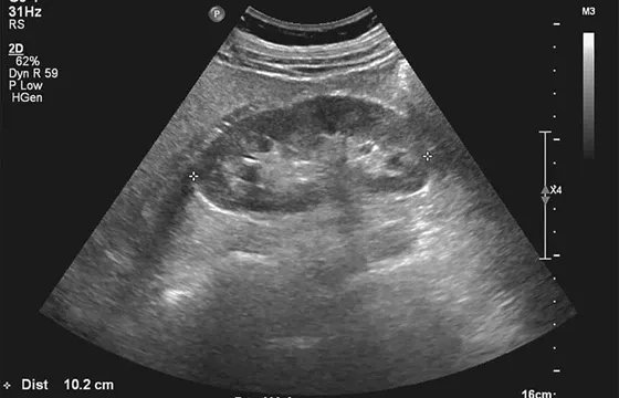 USG układu moczowego jak wygląda