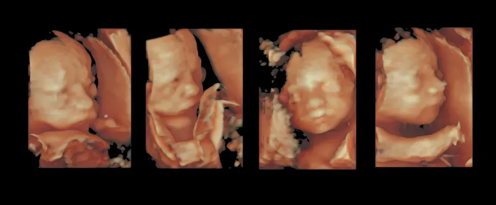 USG trzeciego trymestru ciąży