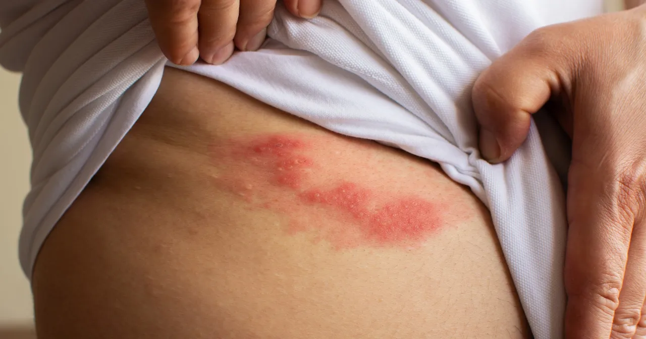 Sk&oacute;ra z wysypką i pęcherzykami, wskazująca na p&oacute;łpasiec. Dowiedz się, jak złagodzić b&oacute;l przy p&oacute;łpaścu.