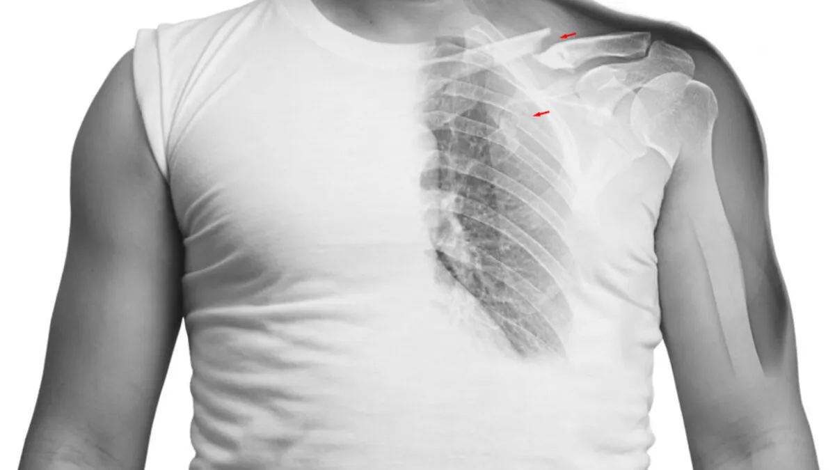 Stłuczenie żeber objawy