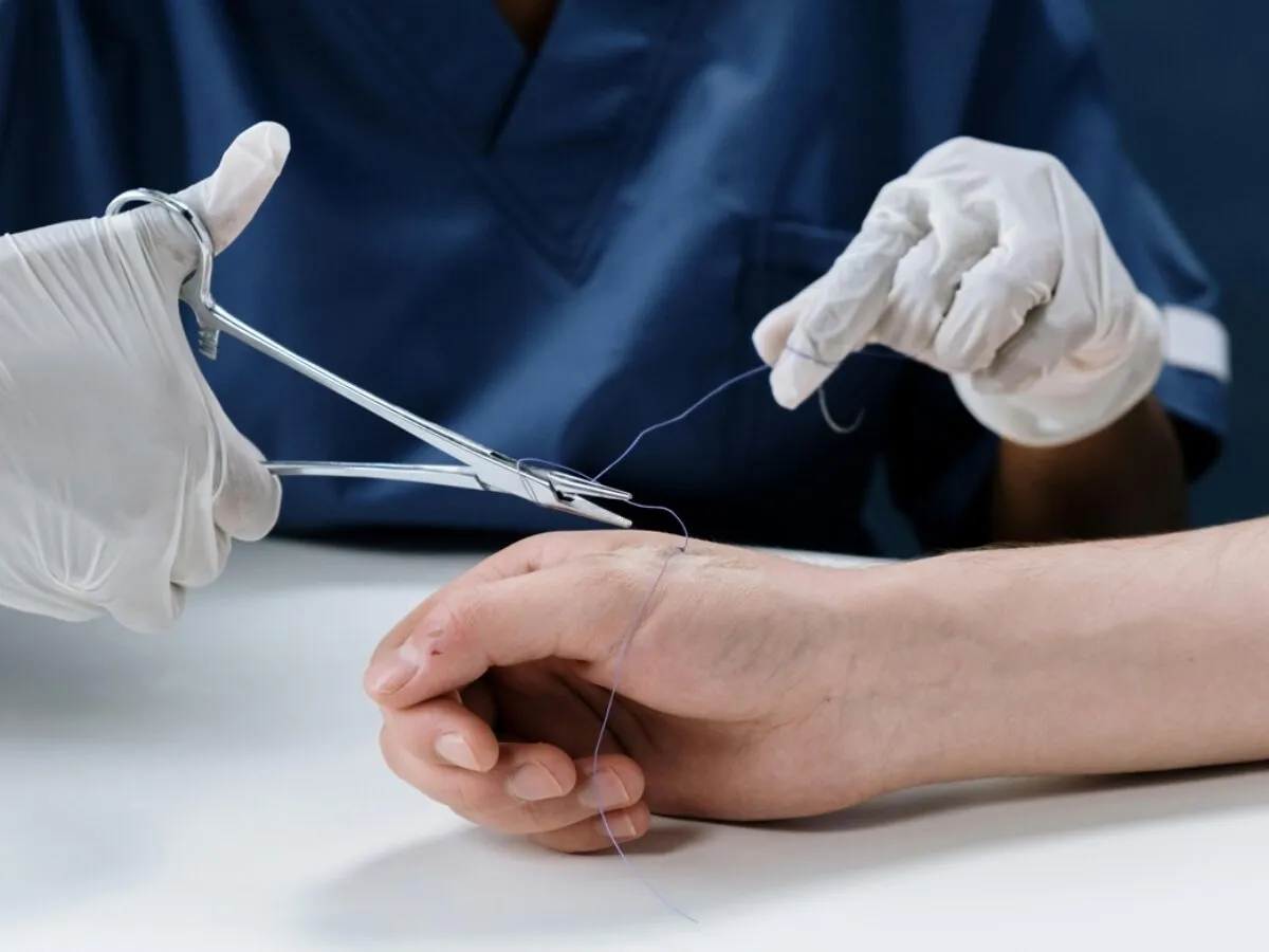Lekarz zakłada szwy na dłoń pacjenta. Warto pamiętać o możliwości uzyskania odszkodowanie za szwy po wypadku.