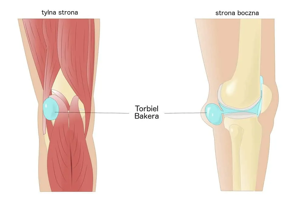Torbiel Bakera schemat anatomia kolana
