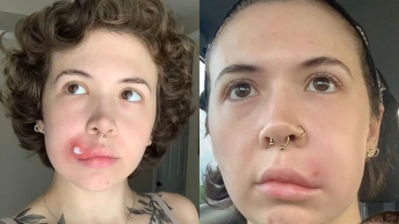 Rodzaje zmian skórnych, których nie wolno wyciskać