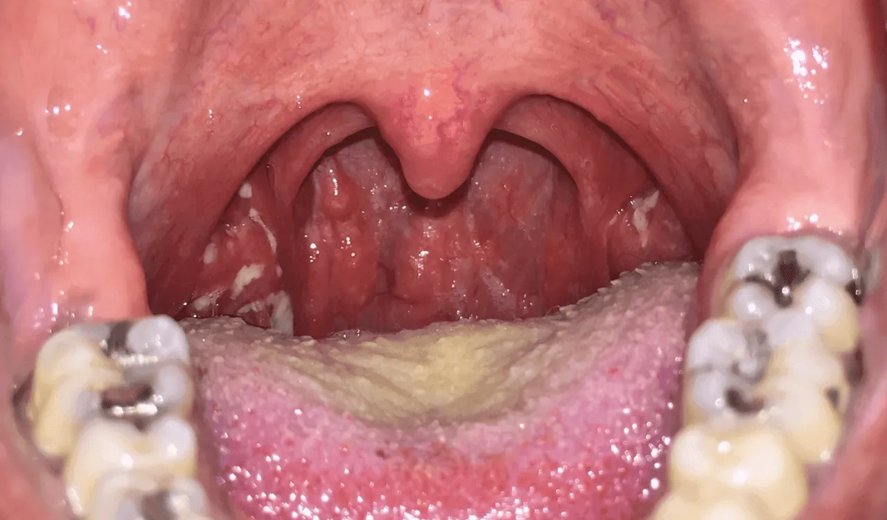 angina paciorkowcowa, nalot na migdałkach