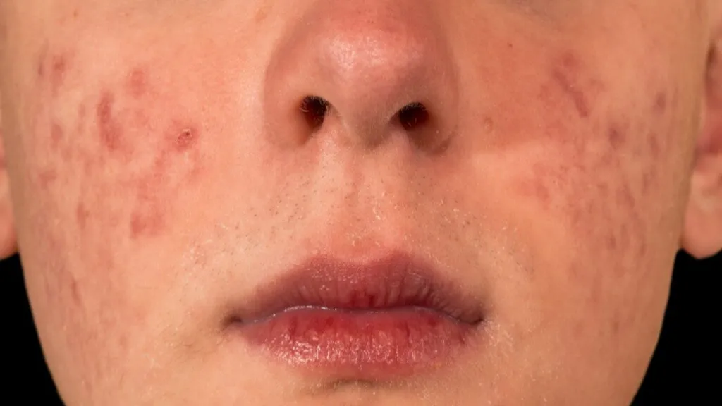 przebarwienia pozapalne po pryszczach rodzaje zdjęcia