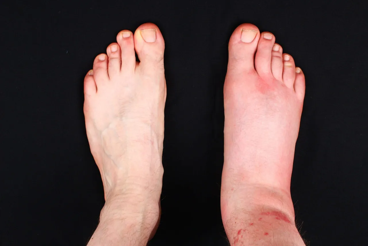 obrzęki kostek choroby nerek