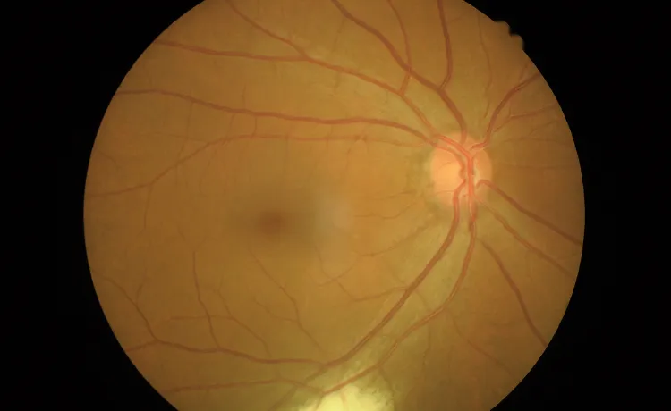 dystrofia plamki ż&oacute;łtej siatk&oacute;wka oka