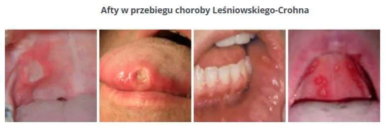 Zdjęcie Choroba Leśniowskiego-Crohna: objawy w jamie ustnej, które musisz znać