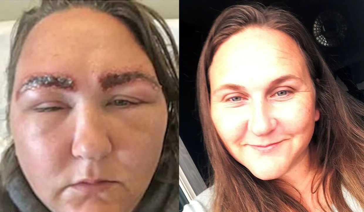 reakcja alergiczna henna brwi