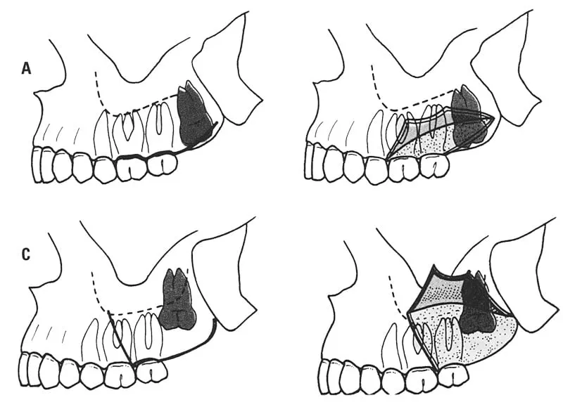 Zabiegi chirurgiczne na dziąsłach schemat