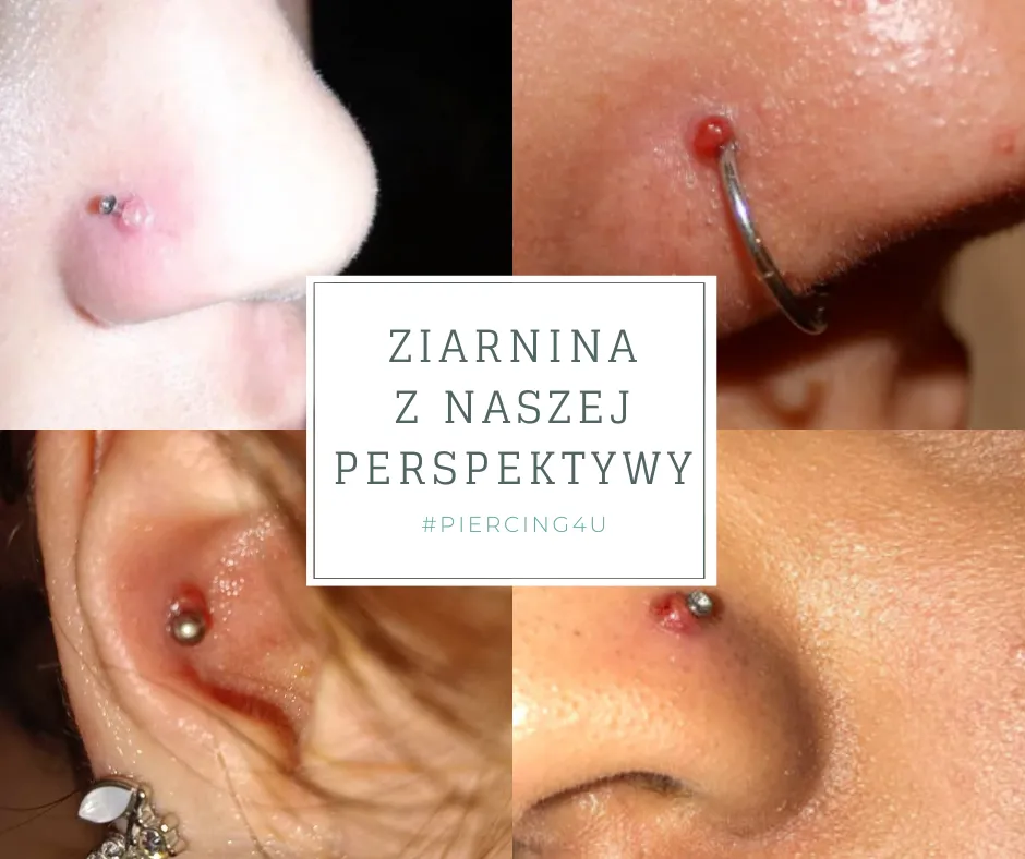 infekcja kolczyka w nosie, ziarnina piercing nosa