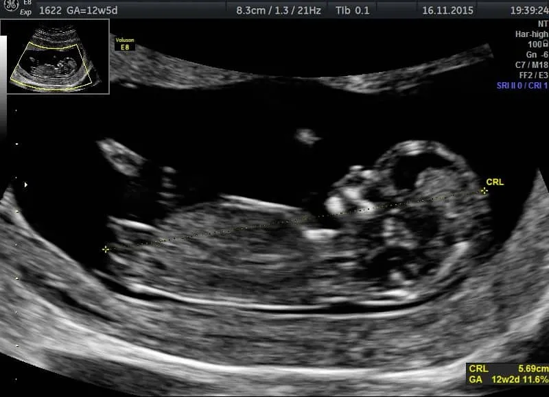 USG I trymestru płodu pomiary NT CRL