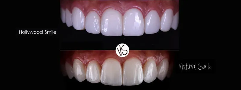 Korona zębowa pełnoceramiczna vs metalowo-porcelanowa por&oacute;wnanie