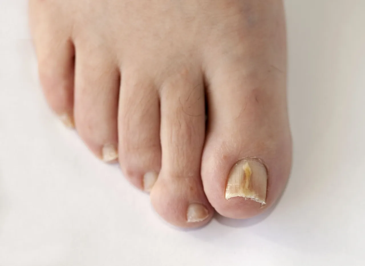 domowe sposoby na żółte paznokcie u nóg