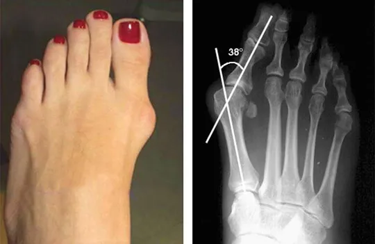 haluks promieniowanie bólu stopy