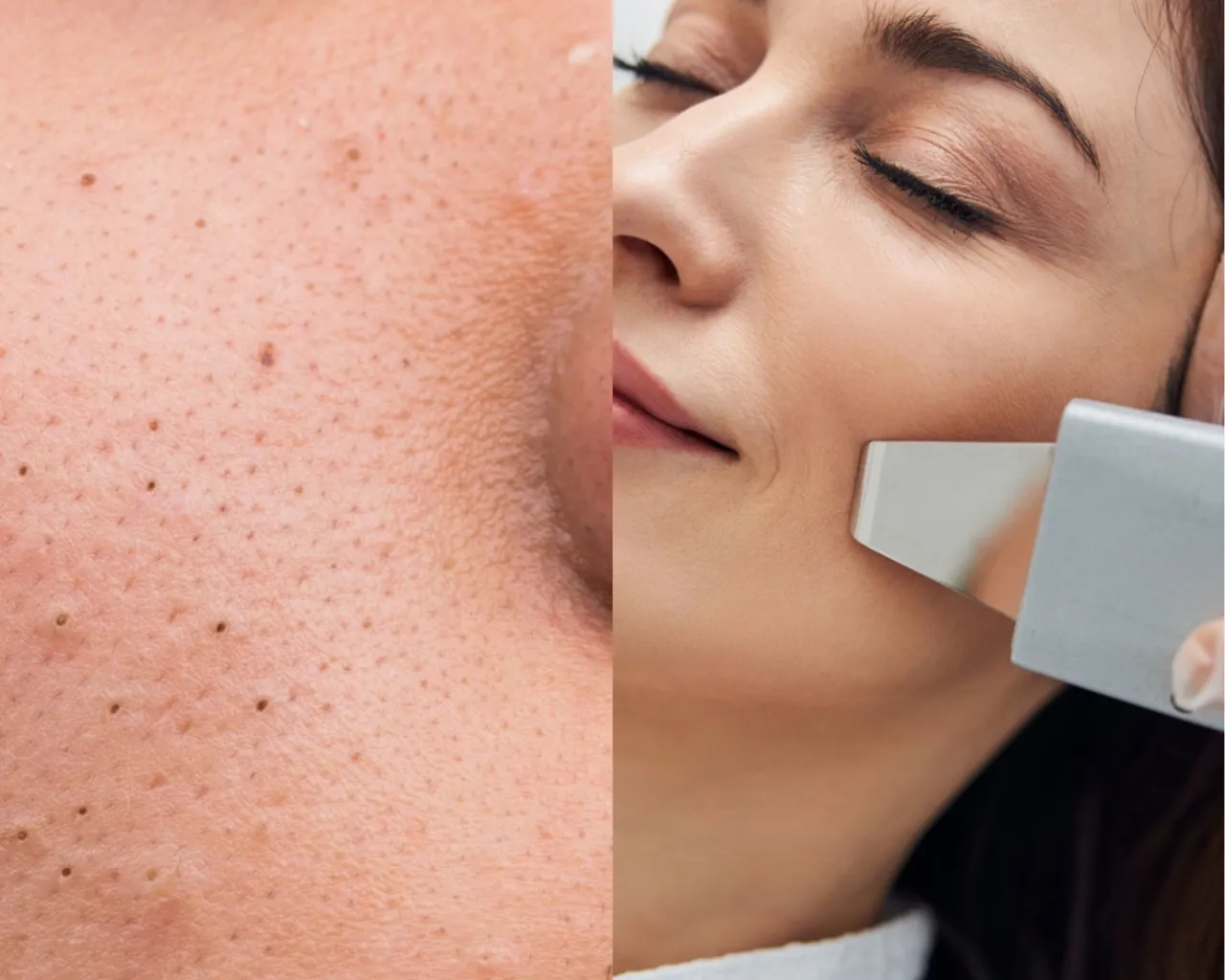 efekty regularnego peelingu kawitacyjnego