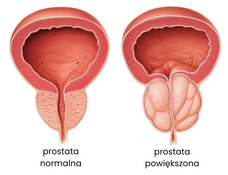 Zdjęcie Jak leczyć przerost prostaty? Skuteczne metody i porady dla pacjentów