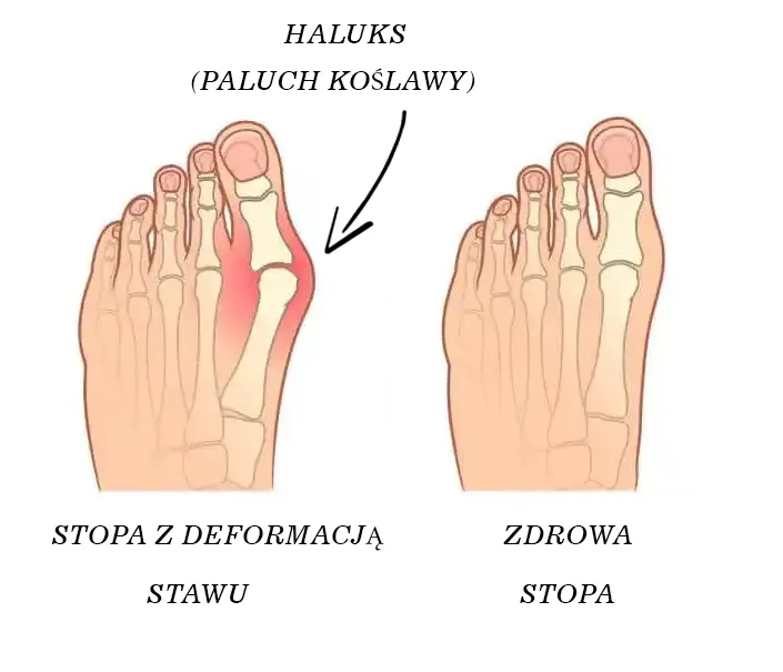 Zdjęcie Dna moczanowa czy haluksy: jak uniknąć bólu i deformacji stóp