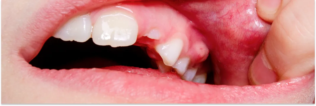 Zdjęcie Ropień dziąsła: jak leczyć? Domowe sposoby i pomoc dentysty