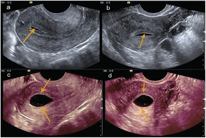 Porównanie HSG i Sono-HSG
