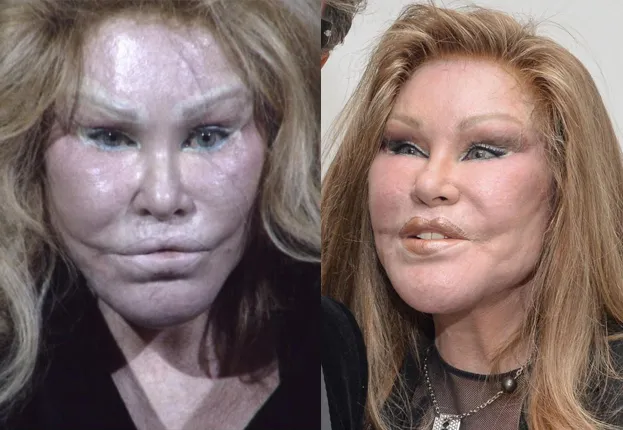 kobieta przed i po operacji plastycznej uśmiechnięta