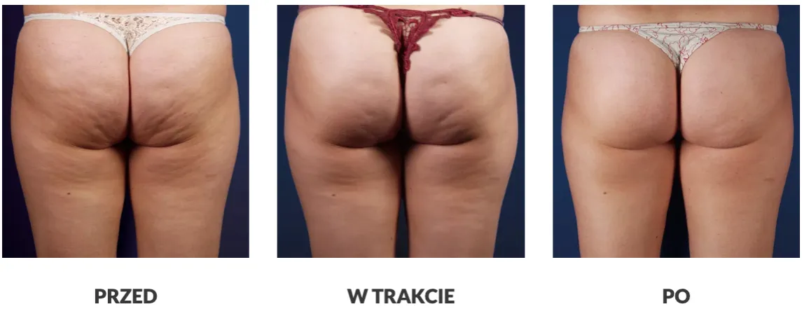 zabiegi endermologia fala uderzeniowa