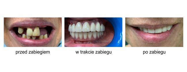 implanty całej szczęki przed i po