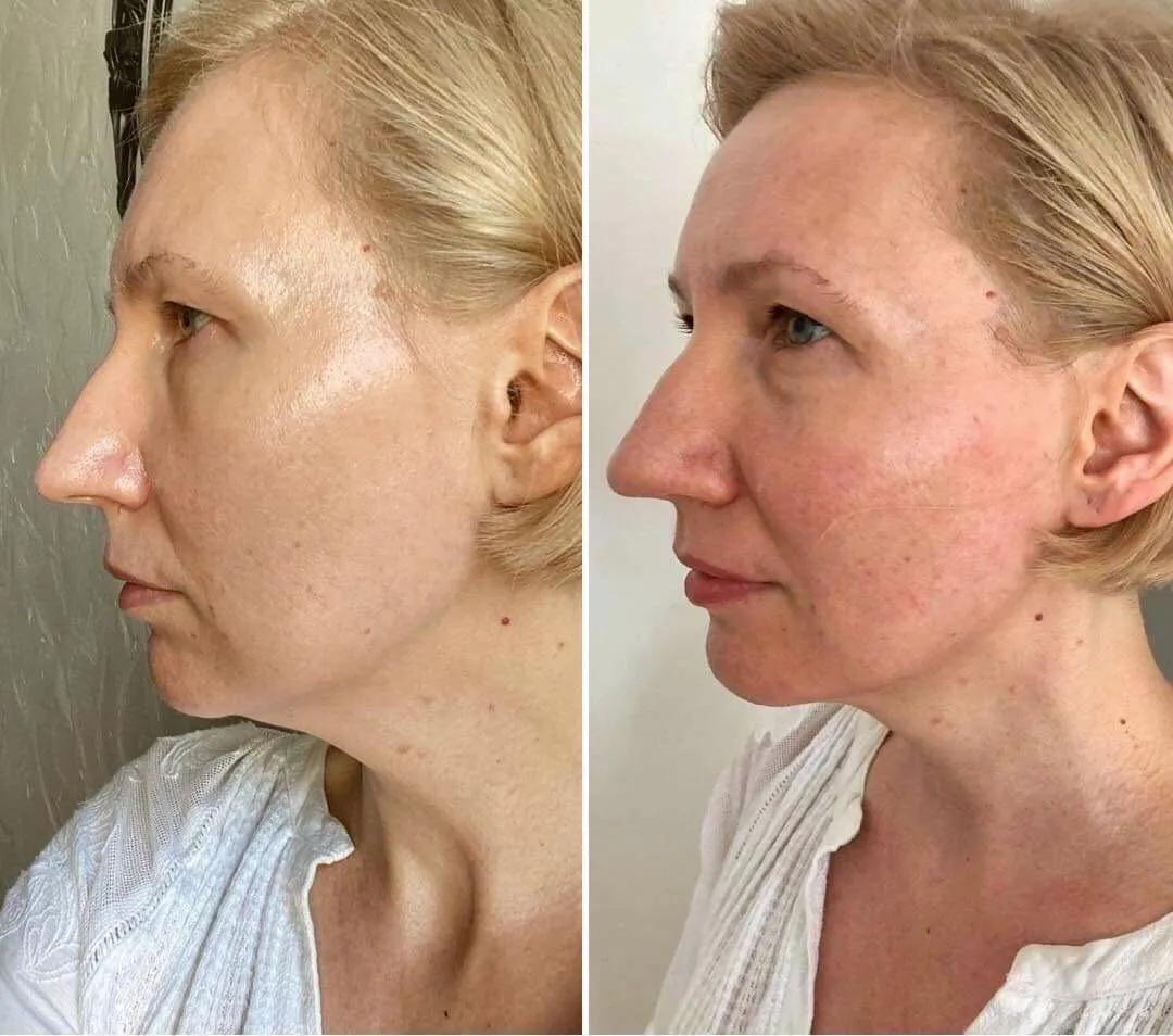 japoński masaż Kobido przed i po efekty