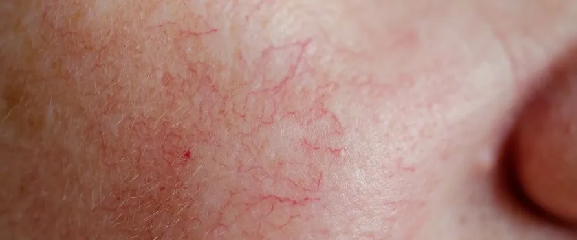 Cera naczynkowa objawy, rumień, teleangiektazje, pajączki na twarzy