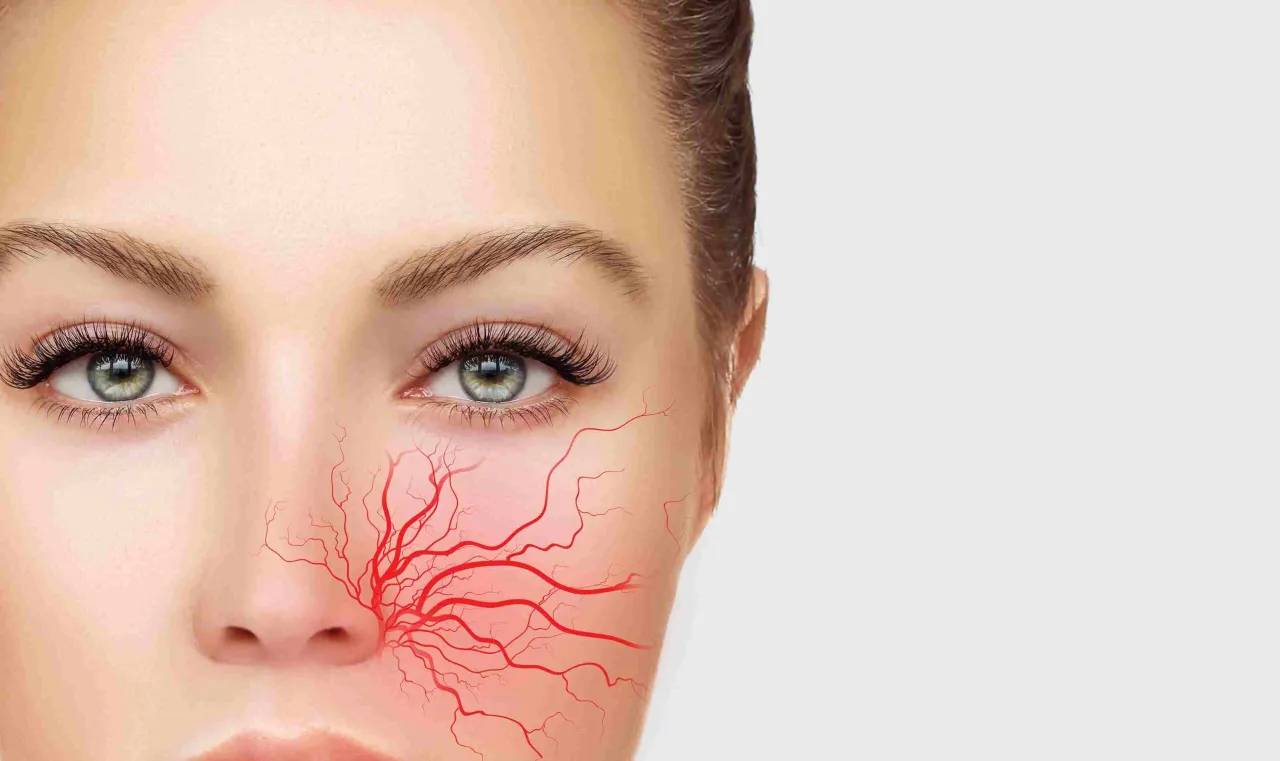 cera naczynkowa teleangiektazje